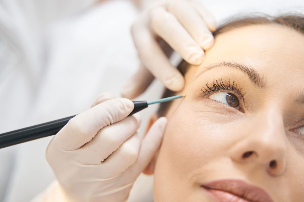 A woman receiving targeted injections in her crow's feet area at Revive and Drip, demonstrating the precision and care provided in Botox treatments. This procedure is one of the many aesthetic treatments available at Revive and Drip, which also offers dermal fillers, IV therapy, and weight loss treatments. The clinic specializes in enhancing clients' natural beauty and wellness through expert-administered, medically supervised procedures, ensuring personalized care and optimal results for every patient.